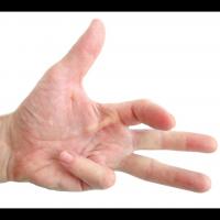 La contracture de Dupuytren - Photo: Sokolenok/ Shutterstock