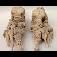 Défomations caractéristiques de la lèpre sur un des 90 squelettes ayant permis de démontrer une origine européenne de la maladie - Photo: Dorthe Dangvard Pedersen