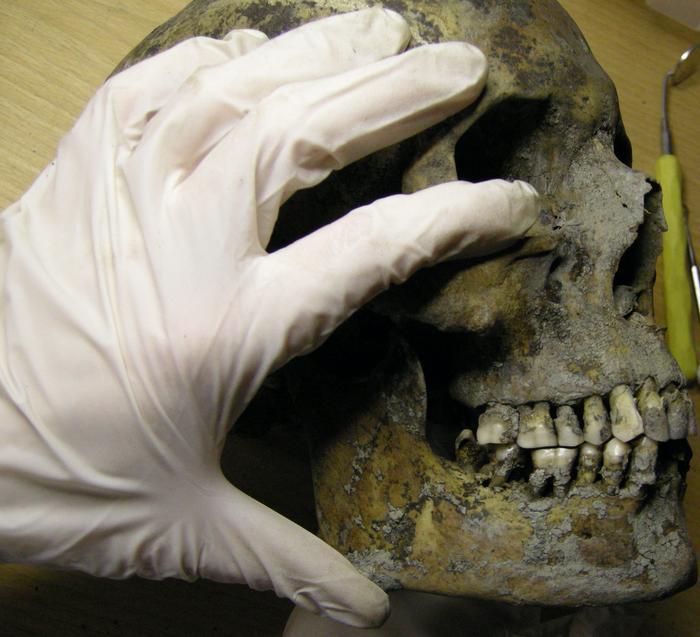 Suède - Examen de la mâchoire et de la dentition d'un individu provenant du site funéraire viking de Varnhem - Photo: Caroline Bertilsson